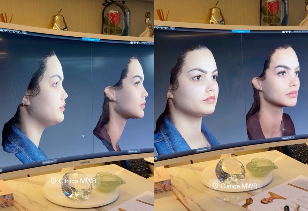 Antes e depois do rosto de Su Freitas — Foto: Reprodução/Instagram