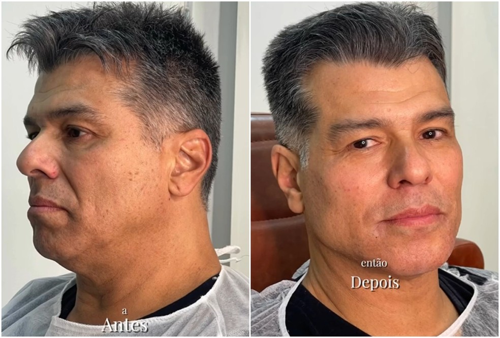 Antes e depois de Mauricio Mattar — Foto: Reprodução/Instagram